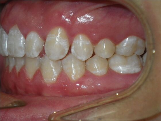 Orthodontic treatment in Phases: Case 12 - After