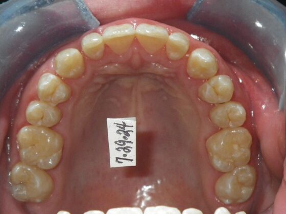 Orthodontic treatment in Phases: Case 12 - After