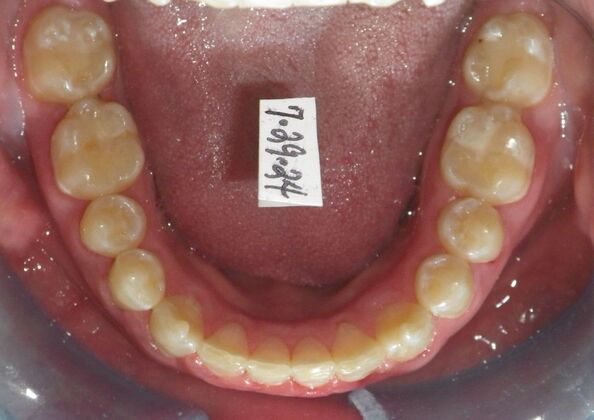 Orthodontic treatment in Phases: Case 12 - After