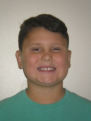 Orthodontic treatment in Phases: Case 12 - Before
