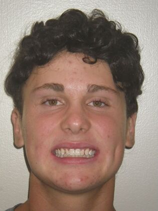 Orthodontic treatment in Phases: Case 12 - After