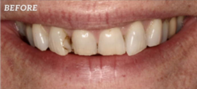 Smile Makeover Full Transformation  - Before