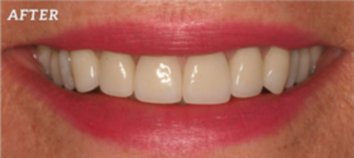 Smile Makeover Full Transformation  - After