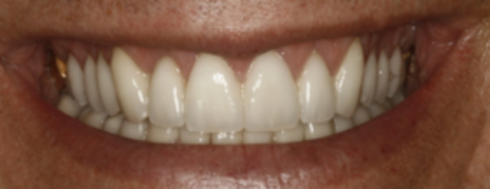 Porcelain Veneers Veneers 1 - After
