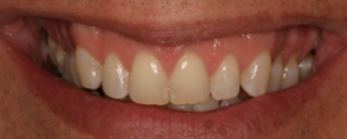 Porcelain Veneers Veneers 1 - Before