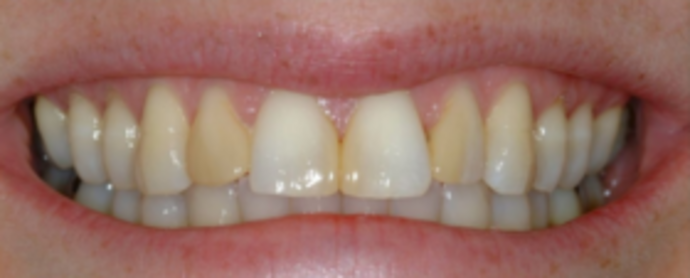 Porcelain Veneers: Veneers 2 - Before