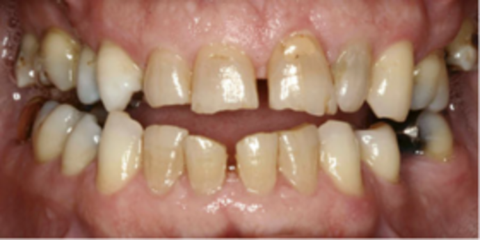 Dental Implants & Full Mouth Reconstruction Full Mouth Reconstruction with Implants - Before
