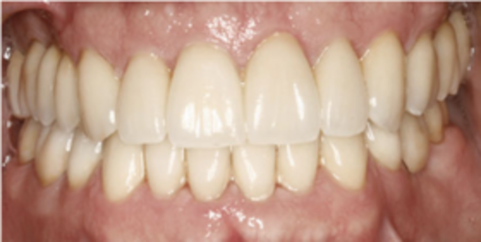 Dental Implants & Full Mouth Reconstruction Full Mouth Reconstruction with Implants - After