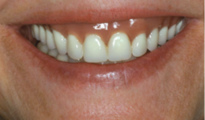 Dental Implants & Full Mouth Reconstruction Implant revision case - Before