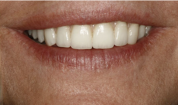 Dental Implants & Full Mouth Reconstruction Implant revision case - After
