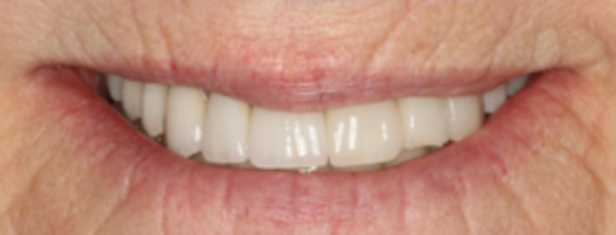 Dental Implants & Full Mouth Reconstruction Loose Teeth - After