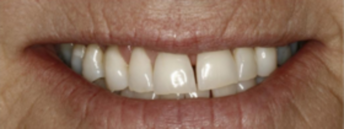 Dental Implants & Full Mouth Reconstruction Loose Teeth - Before