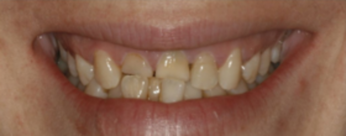 Dental Implants & Full Mouth Reconstruction Smile Transformation - Before