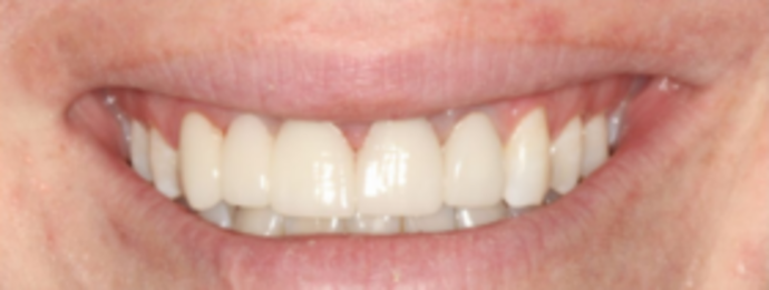 Dental Implants & Full Mouth Reconstruction Smile Transformation - After