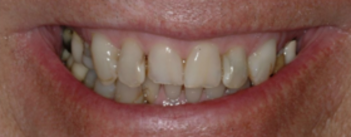 Dental Implants & Full Mouth Reconstruction Another Transformation - Before