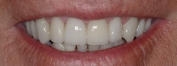 Dental Implants & Full Mouth Reconstruction Another Transformation - After