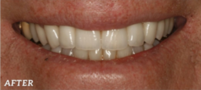 Dental Implants & Full Mouth Reconstruction Severe Wear - After