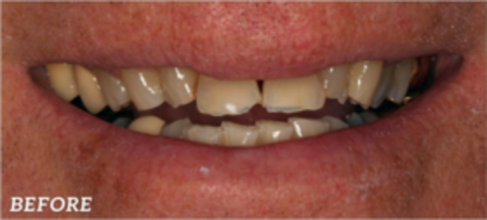 Dental Implants & Full Mouth Reconstruction Severe Wear - Before