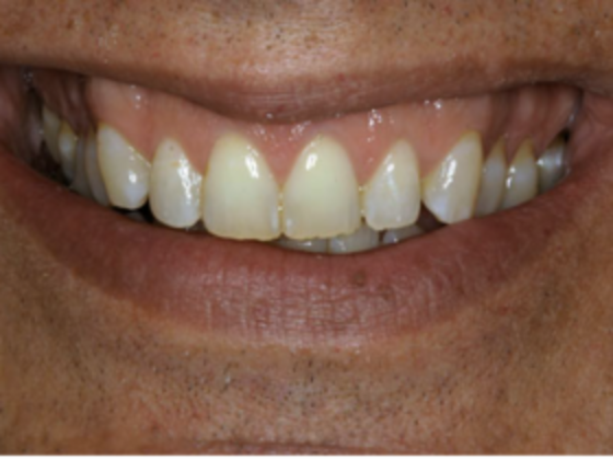 Gummy Smile Excessive and Asymmetric gingival display - Before