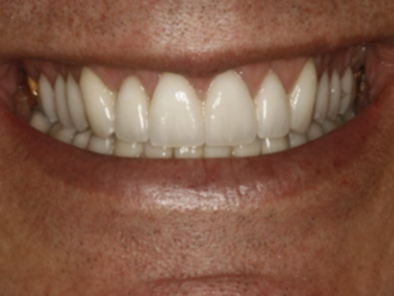 Gummy Smile Excessive and Asymmetric gingival display - After