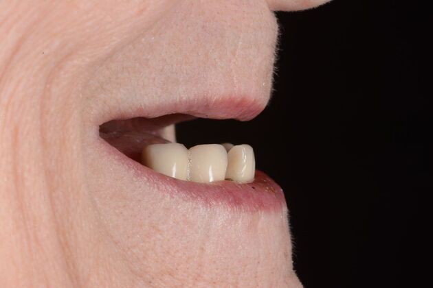 Our Results: ALL ON 5 TEETH IN A DAY - Before