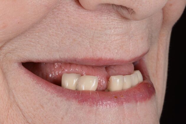 Our Results: ALL ON 5 TEETH IN A DAY - Before