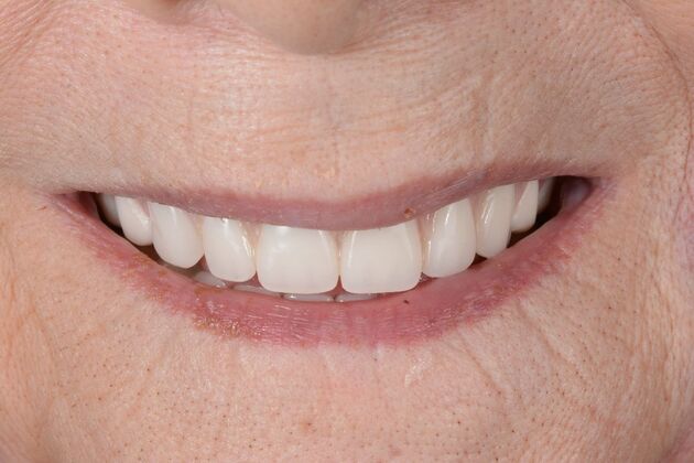 Our Results: ALL ON 5 TEETH IN A DAY - After