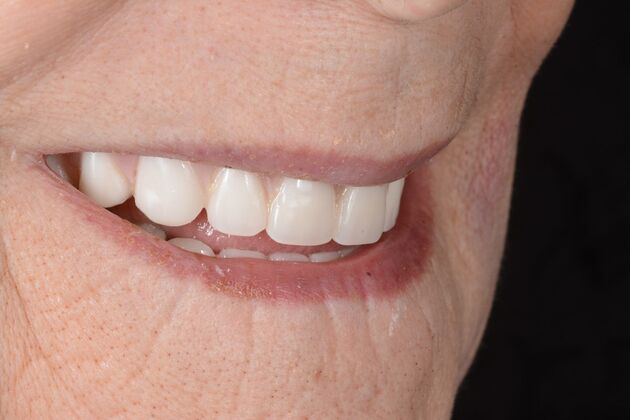 Our Results: ALL ON 5 TEETH IN A DAY - After