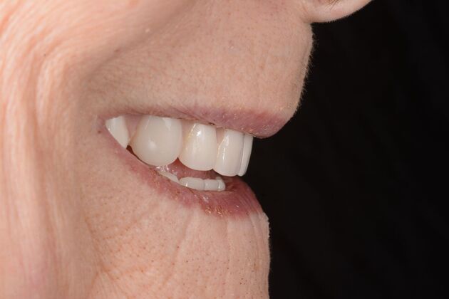 Our Results: ALL ON 5 TEETH IN A DAY - After