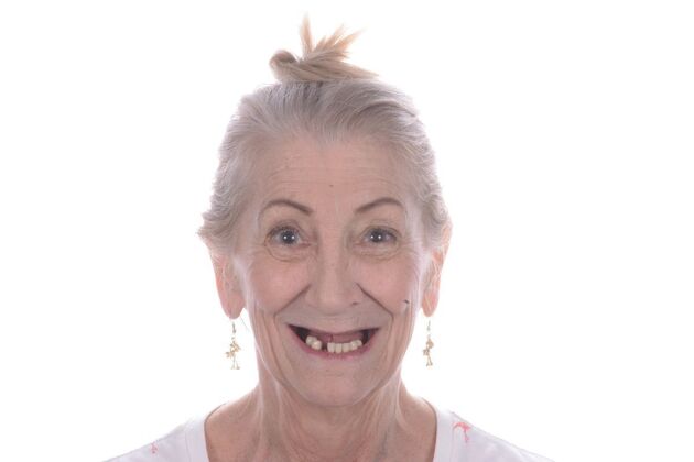 Our Results ALL ON 5 TEETH IN A DAY - Before