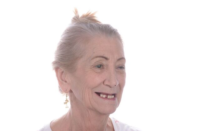 Our Results: ALL ON 5 TEETH IN A DAY - Before