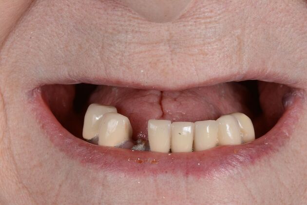 Our Results: ALL ON 5 TEETH IN A DAY - Before