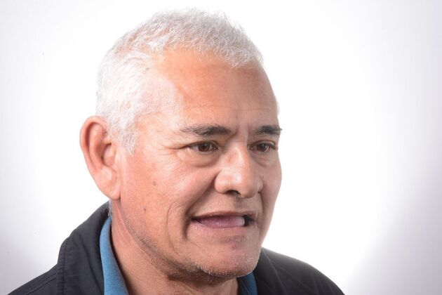 Our Results: ALL ON 4 SAME DAY TEETH - Before