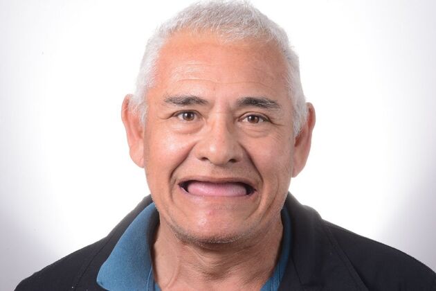 Our Results ALL ON 4 SAME DAY TEETH - Before