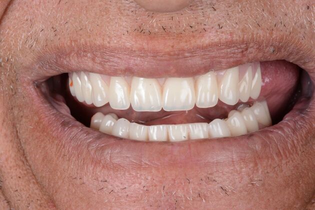 Our Results: ALL ON 4 SAME DAY TEETH - After