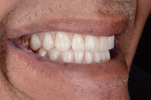 Our Results: ALL ON 4 SAME DAY TEETH - After