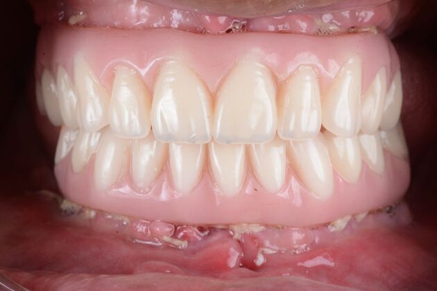 Our Results: ALL ON 4 SAME DAY TEETH - After