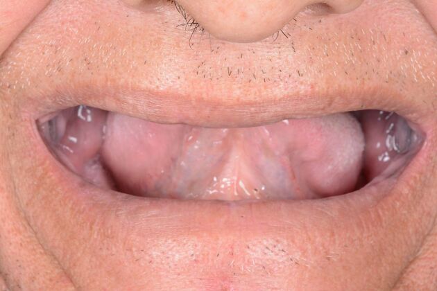 Our Results: ALL ON 4 SAME DAY TEETH - Before