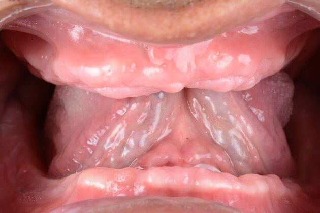 Our Results: ALL ON 4 SAME DAY TEETH - Before