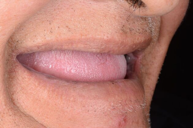 Our Results: ALL ON 4 SAME DAY TEETH - Before