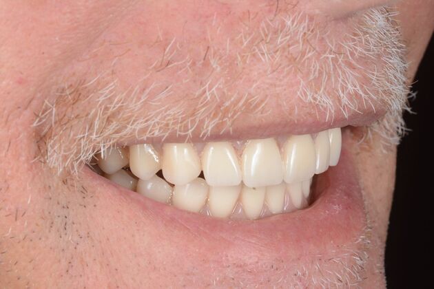 Our Results: ALL ON 6 PATIENT, TEETH IN A DAY - After