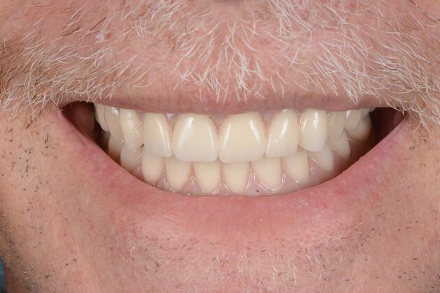 Our Results: ALL ON 6 PATIENT, TEETH IN A DAY - After