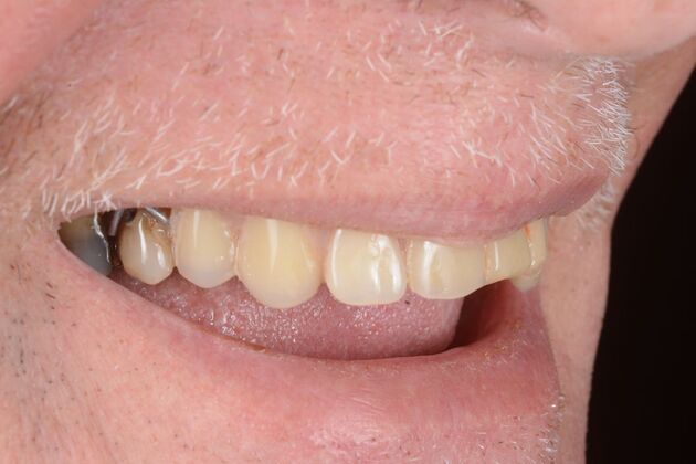 Our Results: ALL ON 6 PATIENT, TEETH IN A DAY - Before