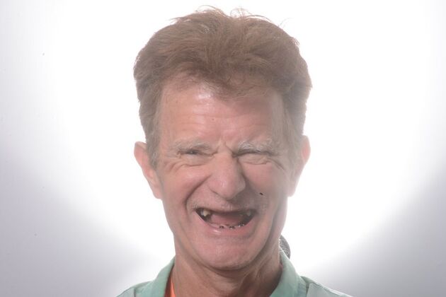 Our Results ALL ON 6 PATIENT, TEETH IN A DAY - Before