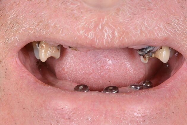 Our Results: ALL ON 6 PATIENT, TEETH IN A DAY - Before