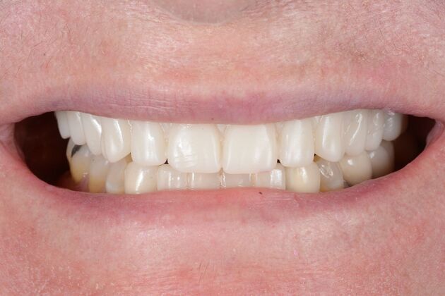 Our Results: ALL ON 4 CASE WHIT SAME DAY TEETH INTERIM ARCHES - After