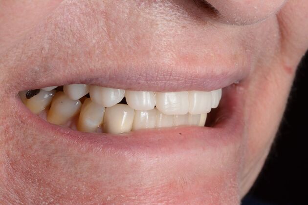 Our Results: ALL ON 4 CASE WHIT SAME DAY TEETH INTERIM ARCHES - After