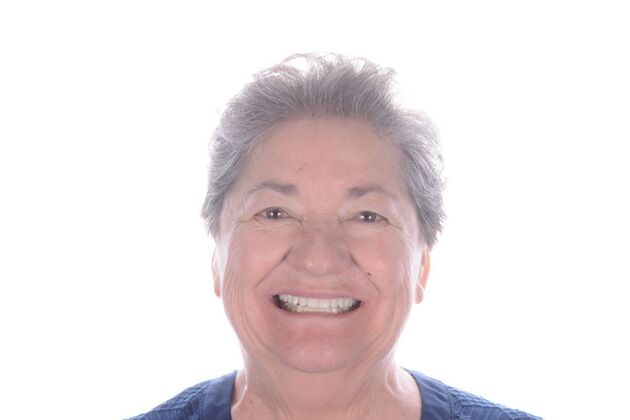 Our Results ALL ON 4 CASE WHIT SAME DAY TEETH INTERIM ARCHES - After