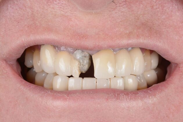 Our Results: ALL ON 4 CASE WHIT SAME DAY TEETH INTERIM ARCHES - Before