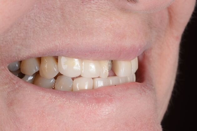 Our Results: ALL ON 4 CASE WHIT SAME DAY TEETH INTERIM ARCHES - Before